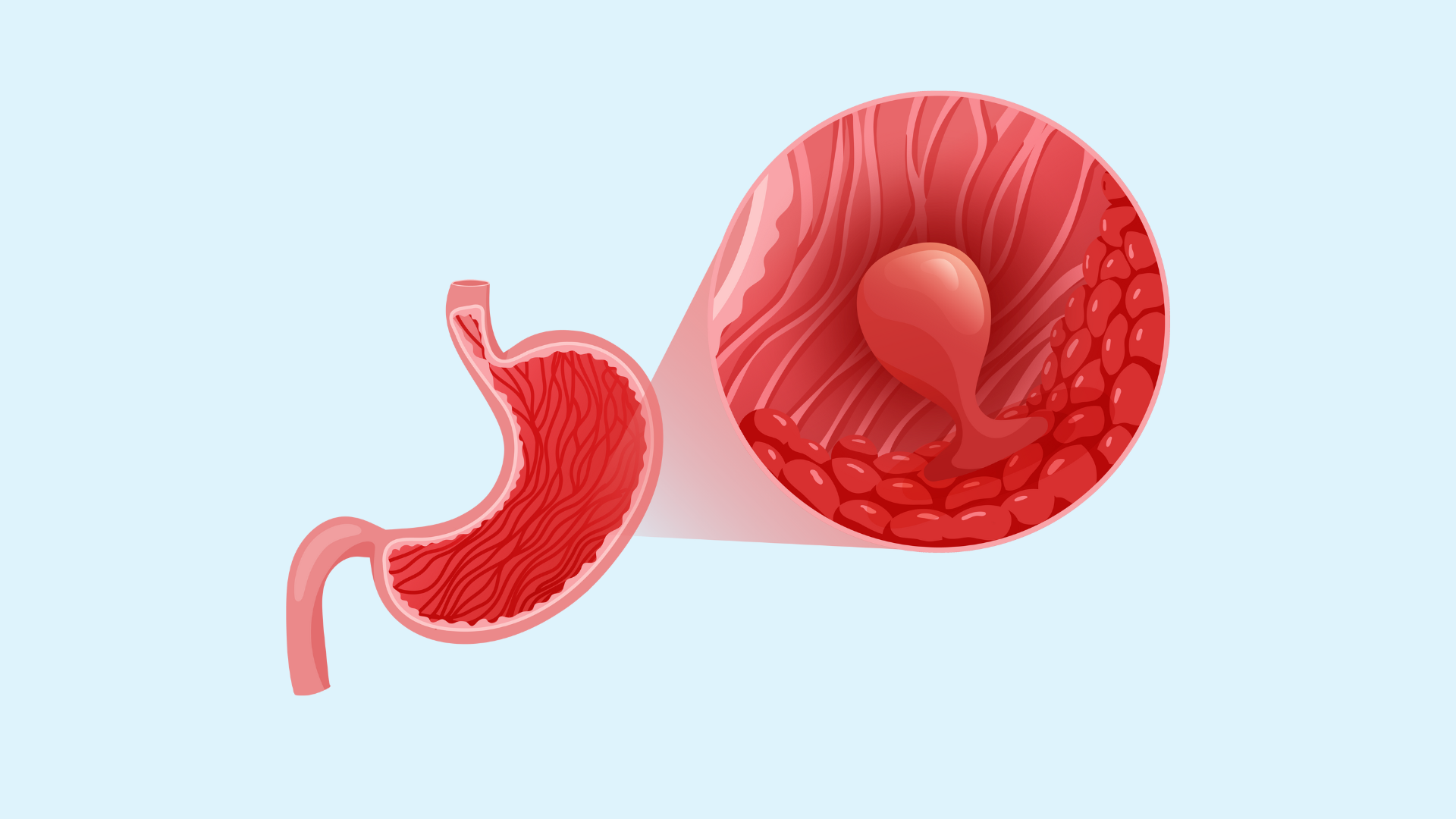 Polyp dạ dày: Nguyên nhân, triệu chứng và cách phòng ngừa ...