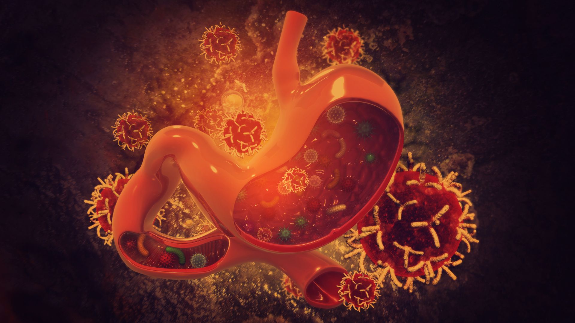 Polyp dạ dày có phải là ung thư không? Dấu hiệu cảnh báo cần tầm soát sớm 2