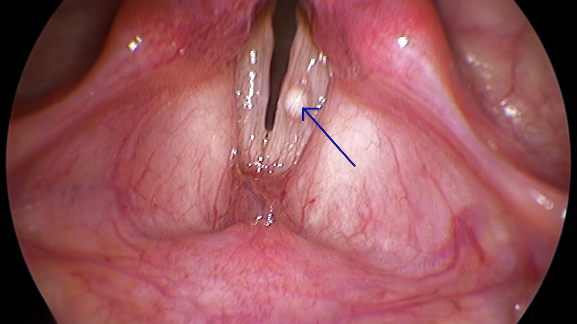 Vị trí polyp thanh quản trên dây thanh