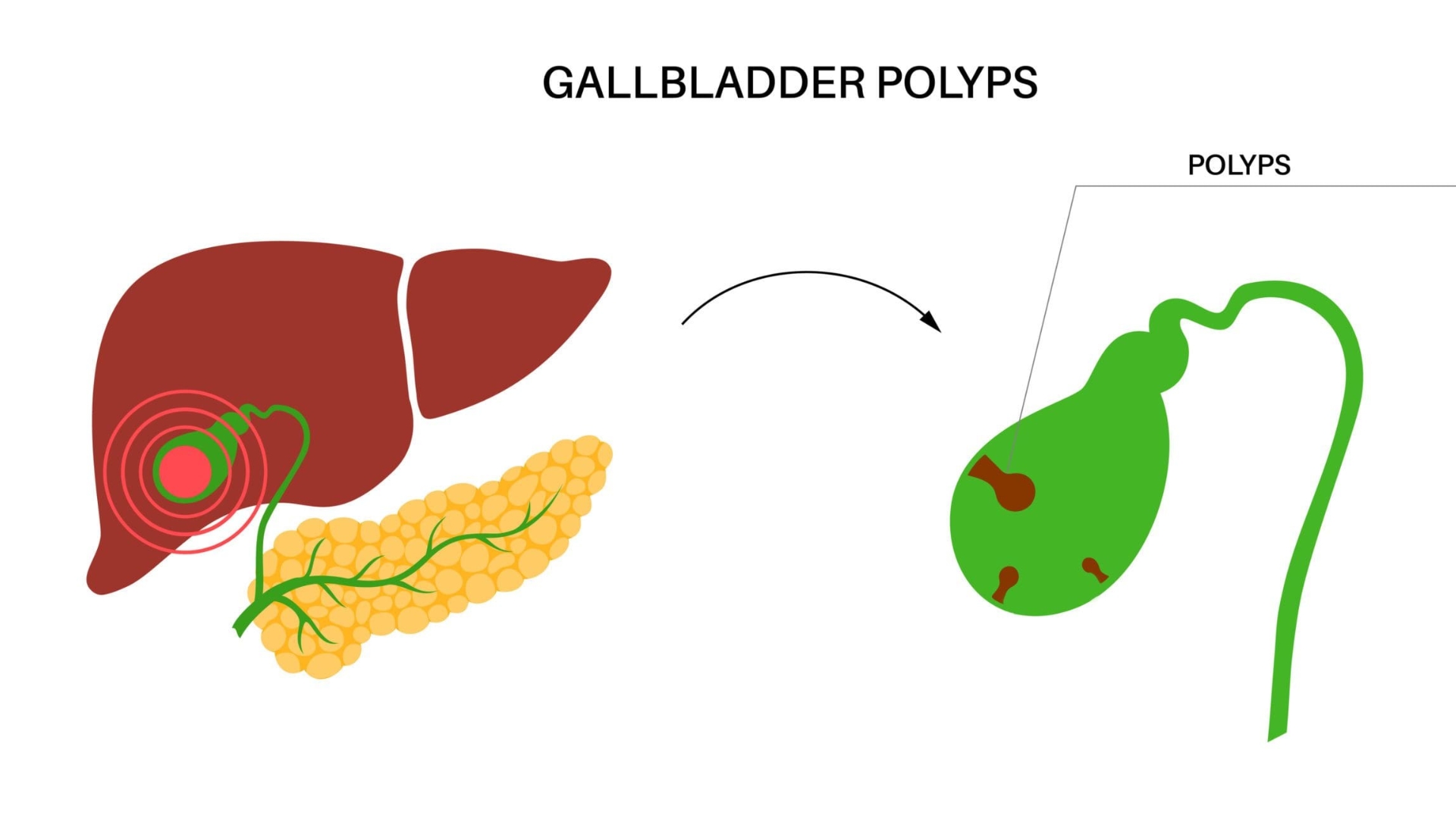 Polyp túi mật 5mm có nguy hiểm không là thắc mắc của nhiều người