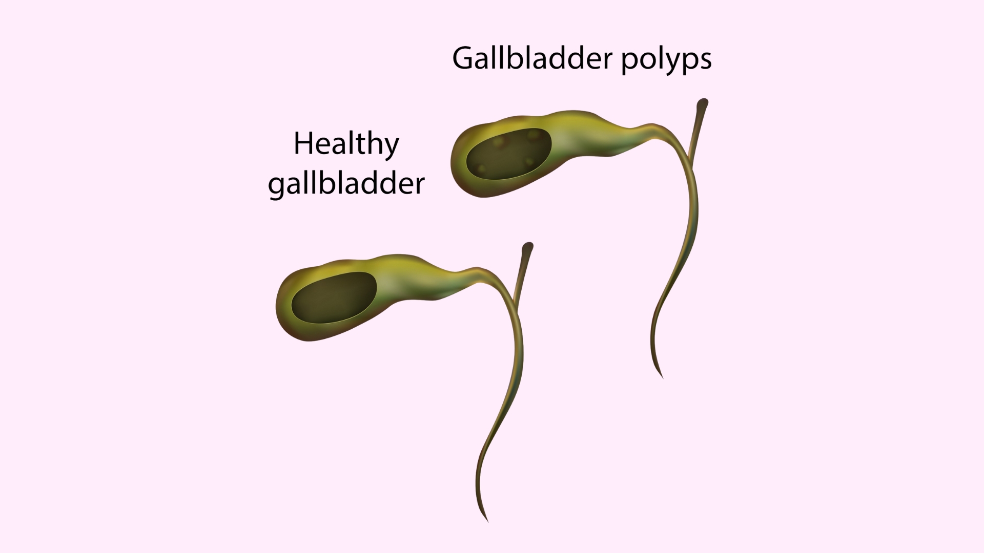 Polyp túi mật 7mm có nguy hiểm không là thắc mắc của nhiều người