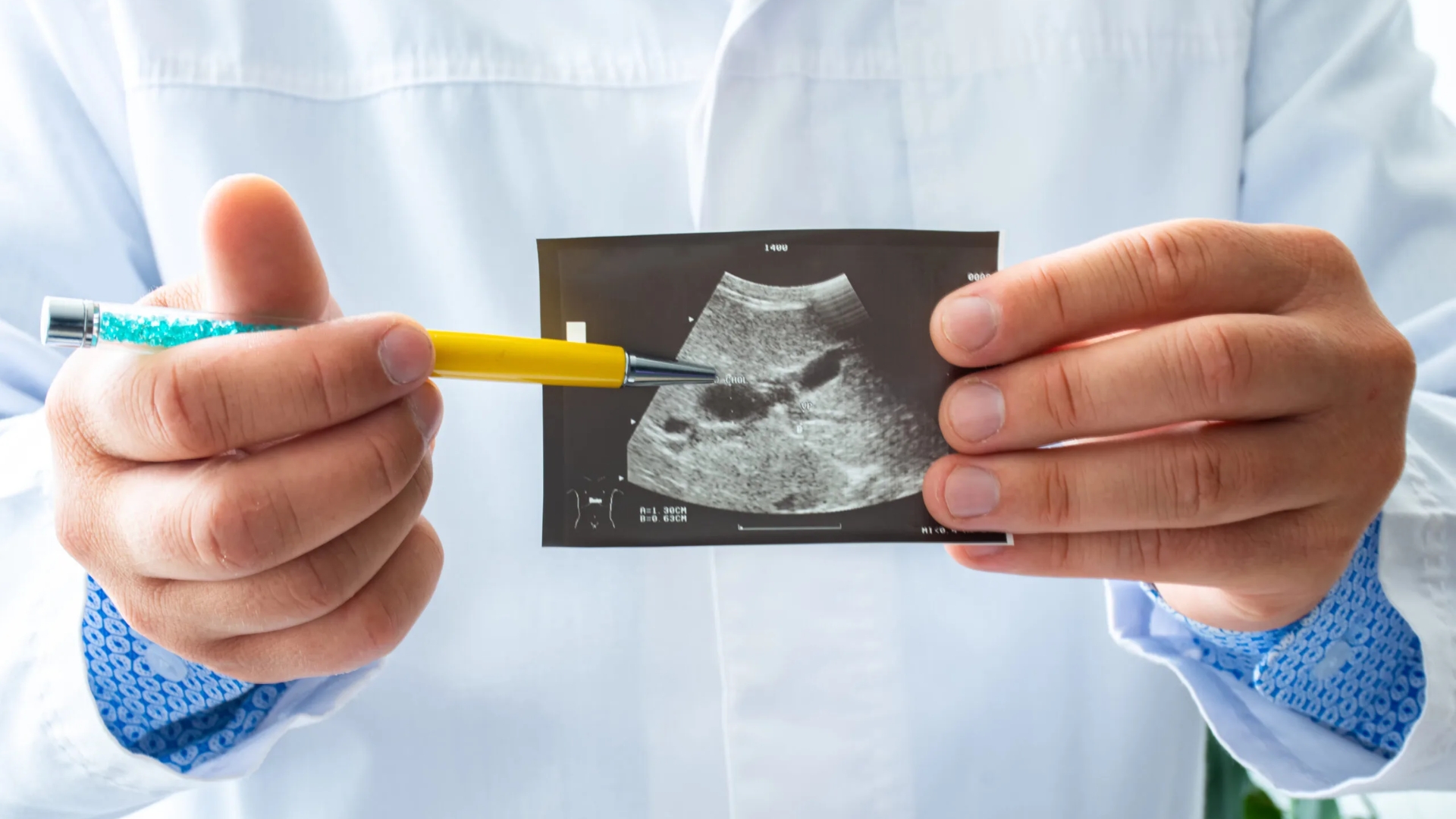 Đối với polyp túi mật 7mm không kèm yếu tố nghi ngờ, bác sĩ thường khuyến cáo theo dõi định kỳ bằng siêu âm mỗi 6 đến 12 tháng