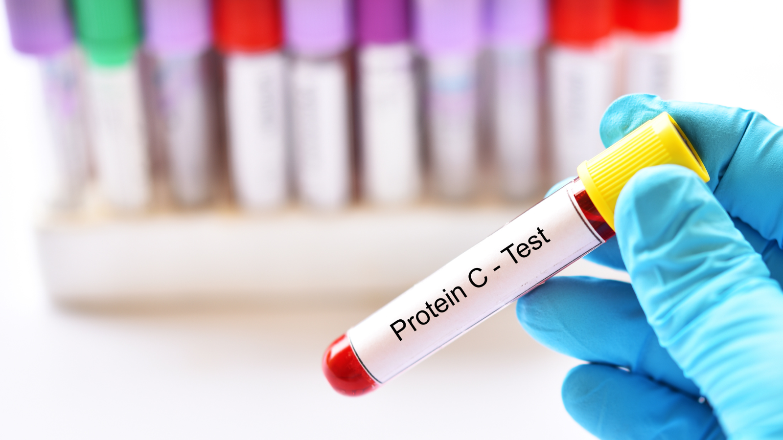 Protein máu là gì? Ý nghĩa của chỉ số protein máu trong xét nghiệm 3