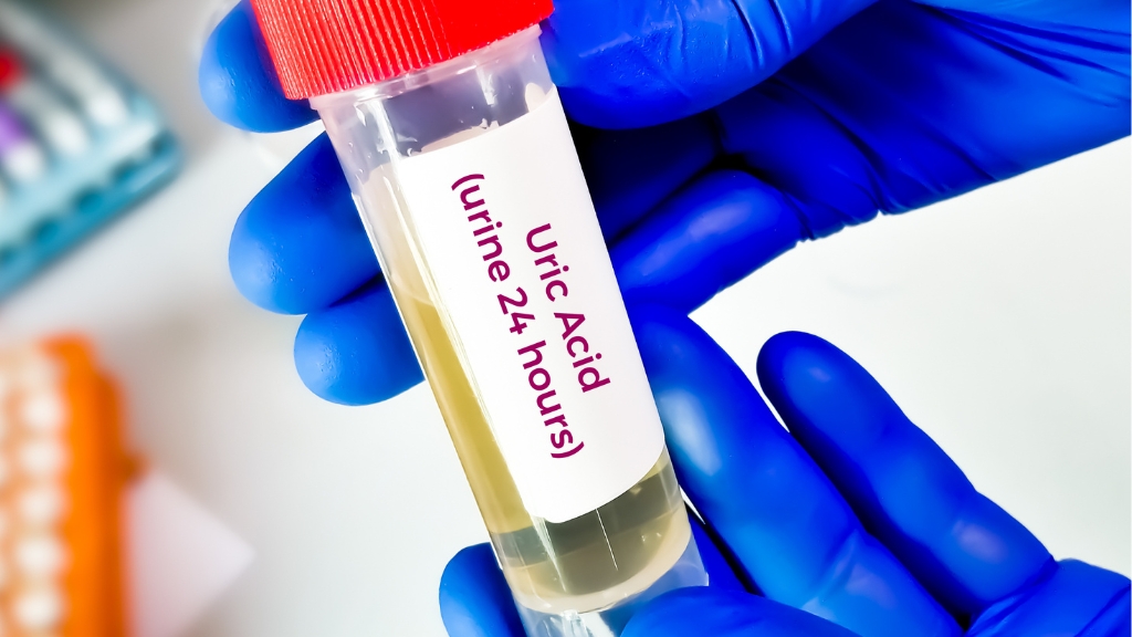 Các xét nghiệm cần thiết để chẩn đoán protein trong nước tiểu chính xác