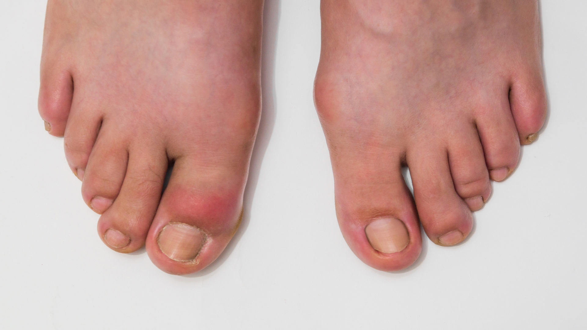 Mối liên hệ giữa purin và bệnh gút bắt nguồn từ quá trình chuyển hóa tự nhiên trong cơ thể