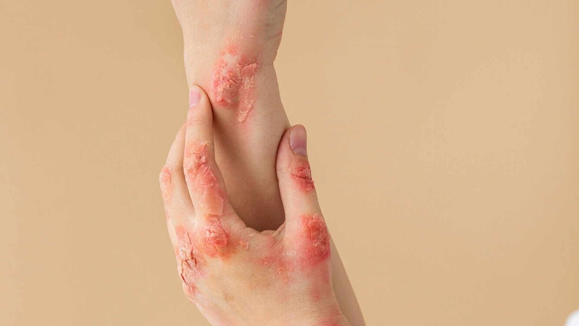 Một số bệnh lý khác như lupus hoặc nhiễm trùng khác có thể gây nhiễu, dẫn đến dương tính HIV giả