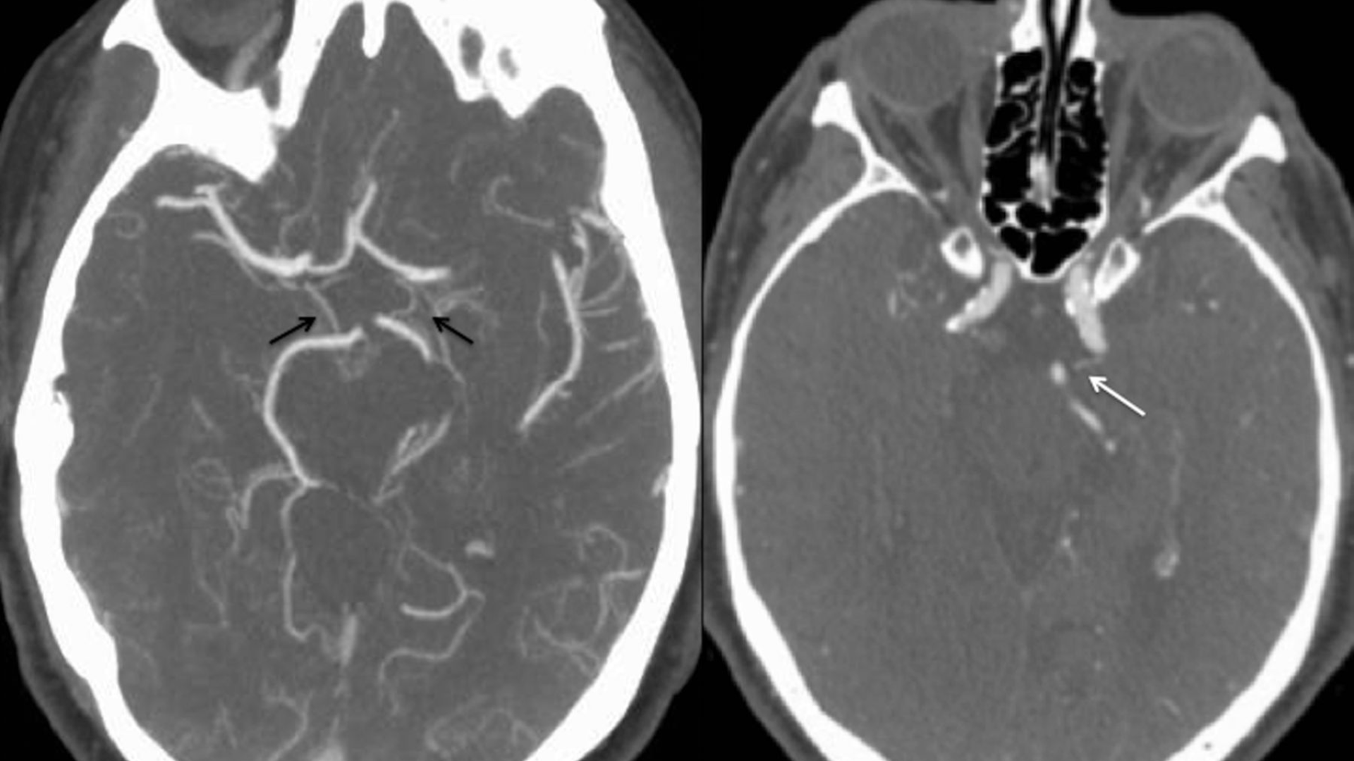 Chụp CT mạch máu não là một kỹ thuật chẩn đoán hình ảnh tương đối an toàn