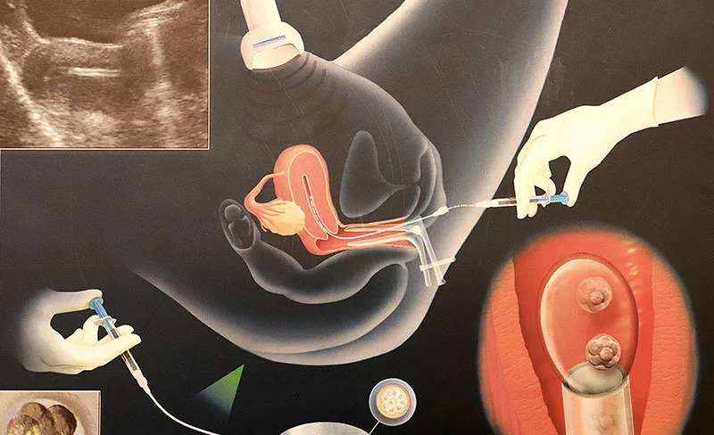 Phôi được chuyển vào tử cung thường sau 3 - 5 ngày kể từ khi chọc hút trứng