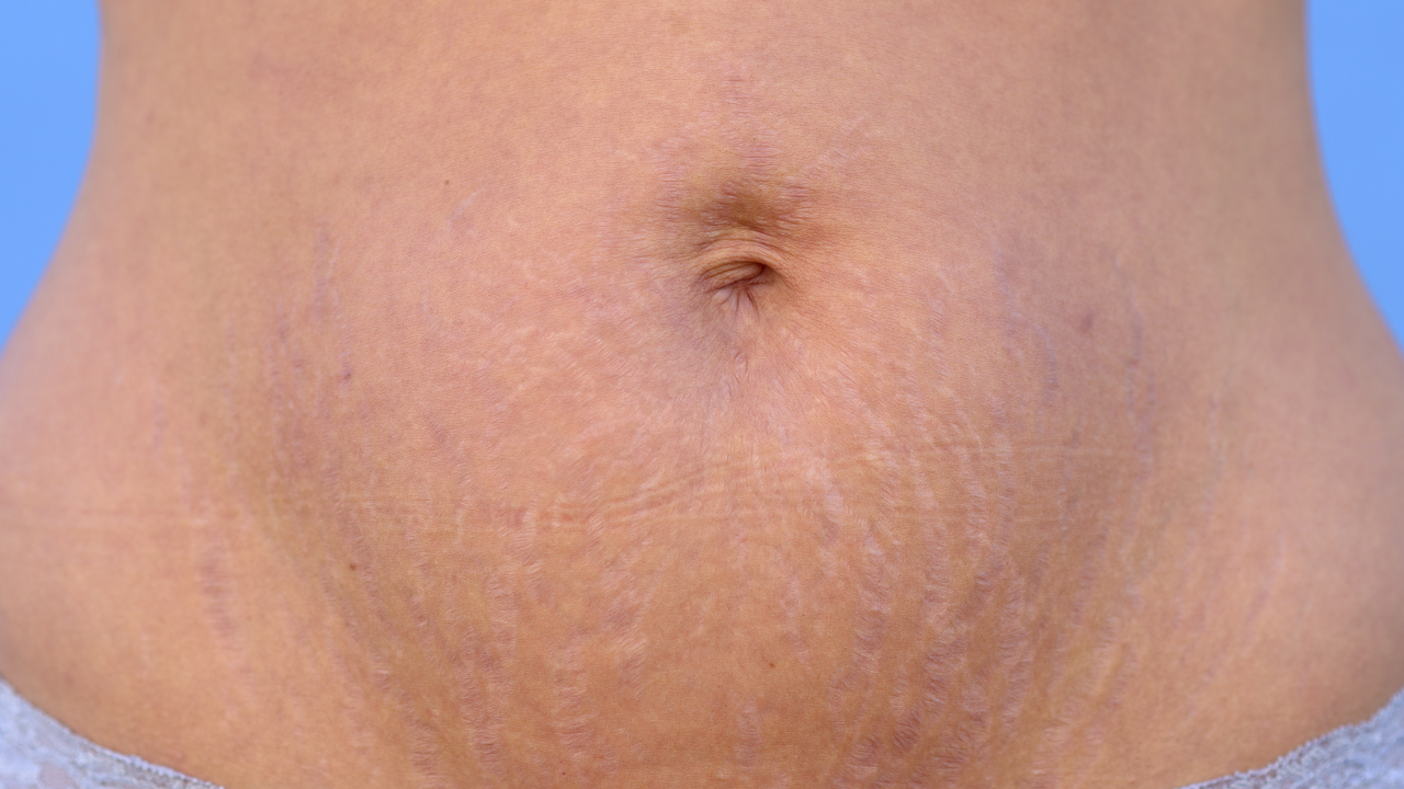 Rạn da sau sinh gây vệt dài có màu đỏ, hồng đậm hoặc tím sẫm