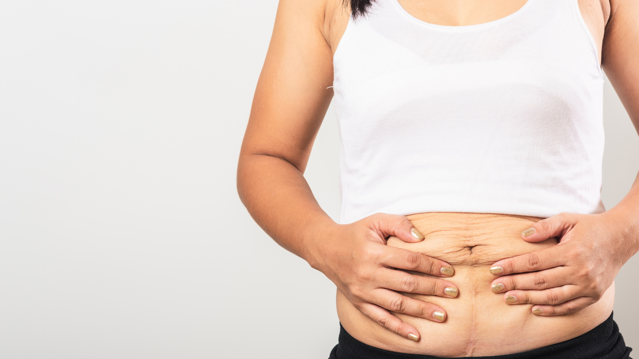 Vết rạn da sau sinh không thể tự biến mất hoàn toàn