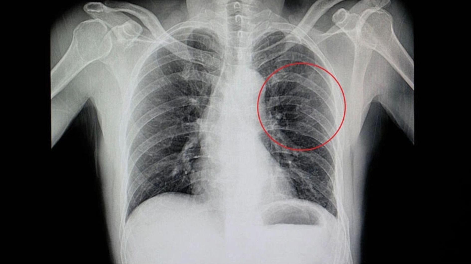 Rạn xương sườn bao lâu thì khỏi là vấn đề được nhiều người quan tâm