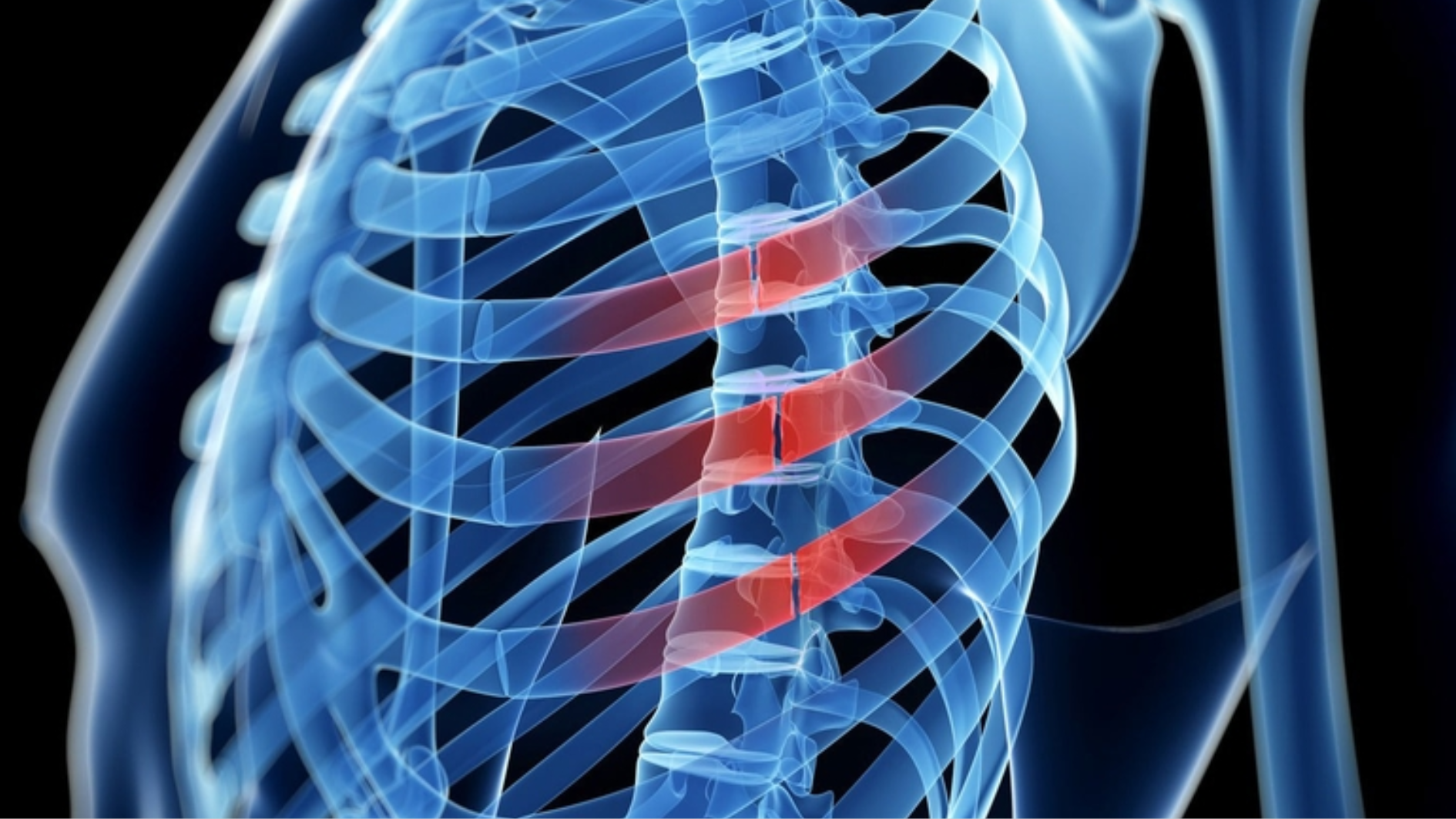 Rạn xương sườn là tình trạng xương sườn có vết nứt trên bề mặt