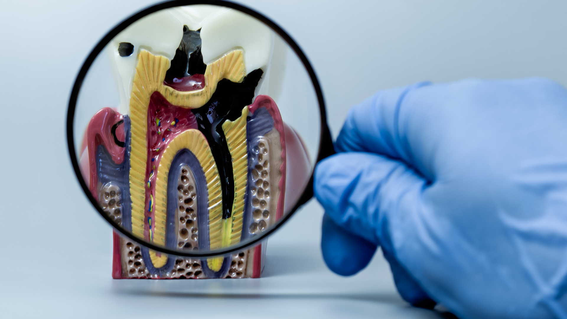 Nếu tình trạng viêm quanh răng khôn tiếp tục không được kiểm soát thì nhiễm trùng có xu hướng lan rộng theo thời gian