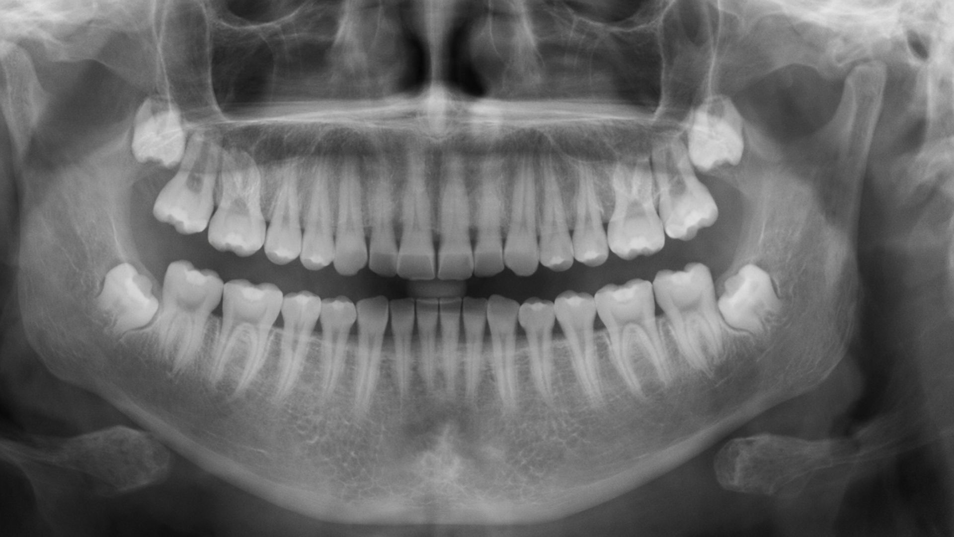 Một người bình thường sẽ có tối đa 4 chiếc răng khôn ở cả 2 hàm