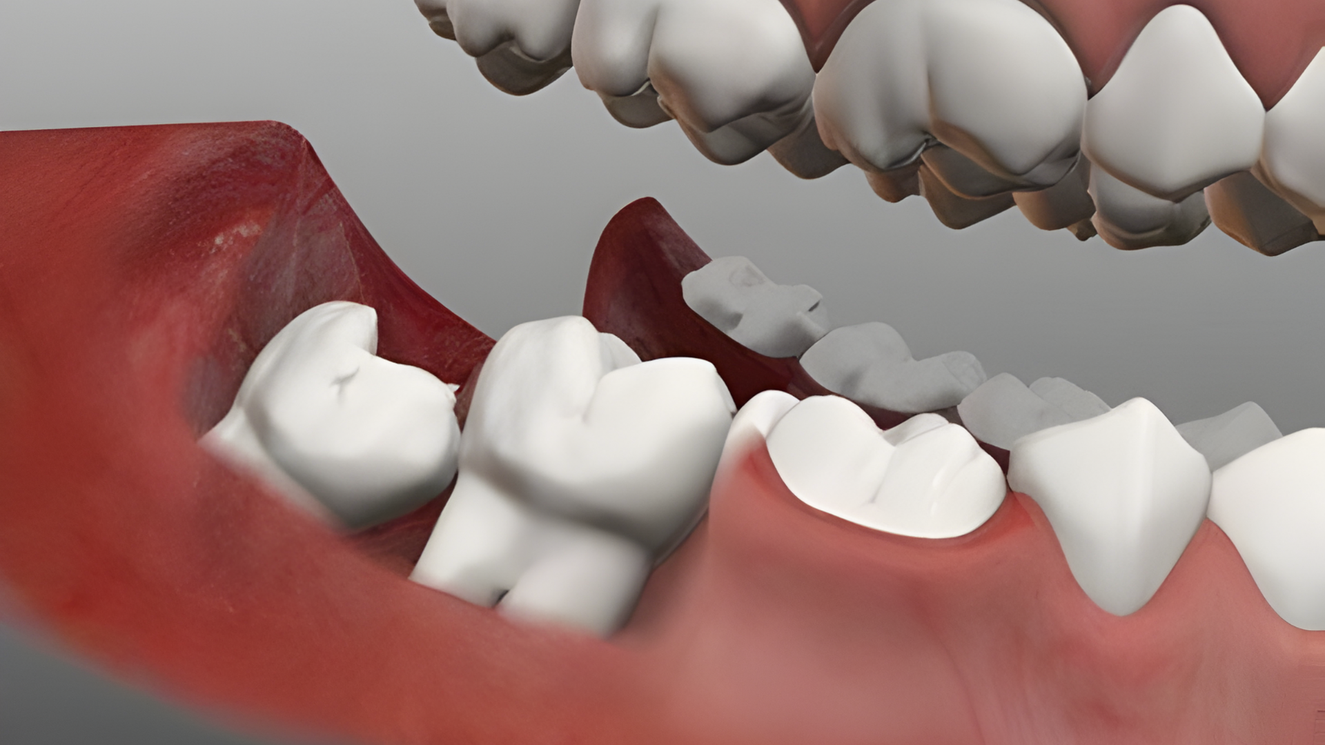 Khi răng khôn nghiêng 45 độ về phía răng số 7, phần tiếp giáp giữa hai răng tạo ra một khe hở khó vệ sinh