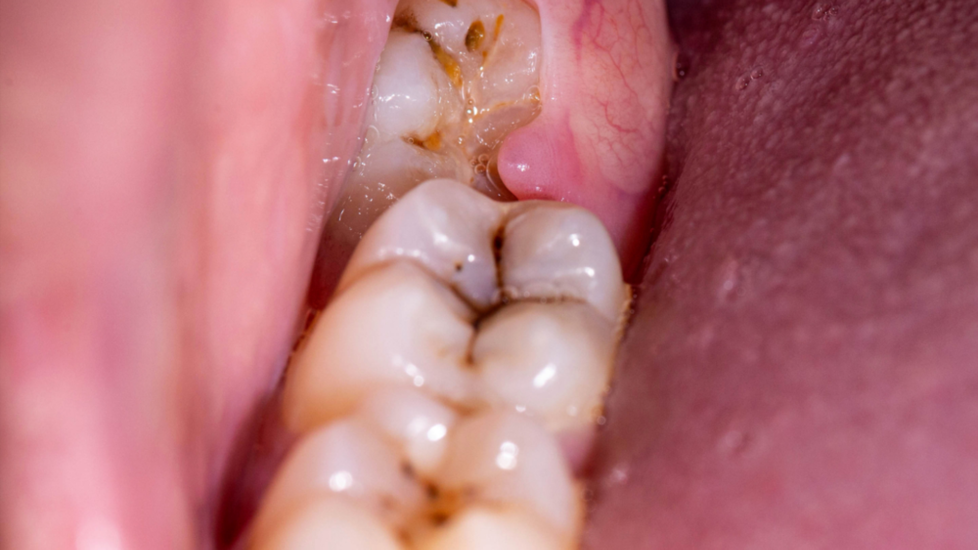 Một trong những biến chứng phổ biến nhất của răng khôn mọc lệch 45 độ là sâu răng số 7