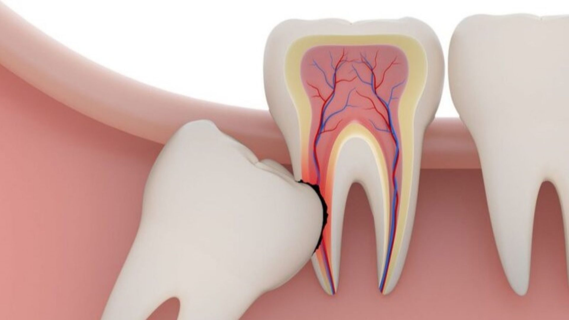Sâu phía xa răng 7 là một trong các biến chứng của răng khôn mọc ngầm