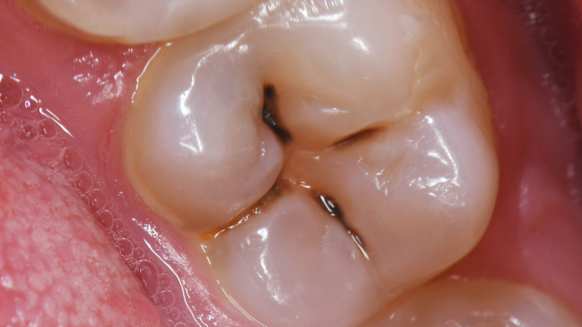 Sâu răng ở vị trí răng số 7 thường tiến triển âm thầm và chỉ được phát hiện khi đã khá sâu