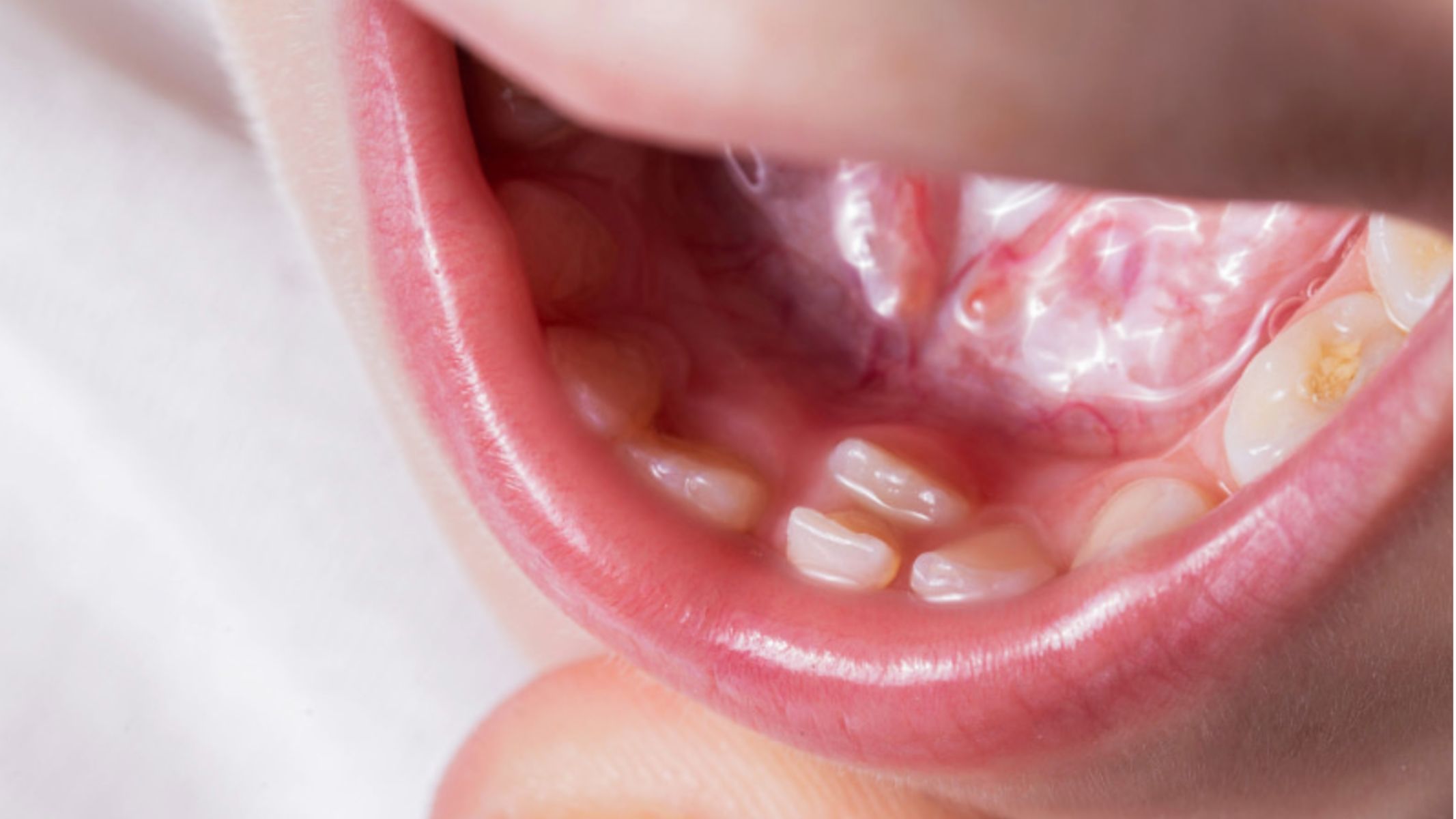 Răng mọc lẫy ở trẻ là gì? Dấu hiệu và cách xử lý 2