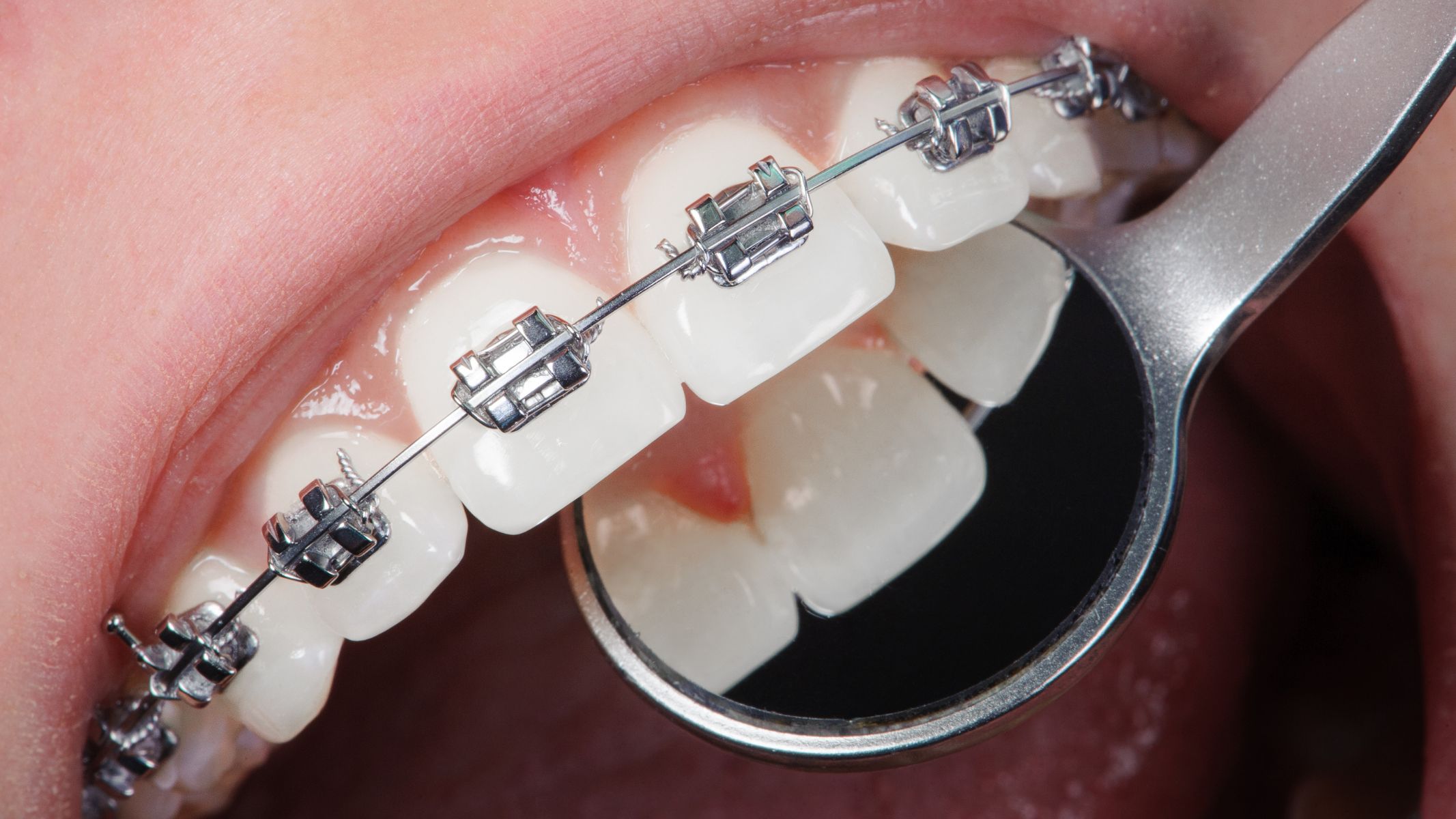 Răng mọc ngược có nguy hiểm không? Cách xử lý 5