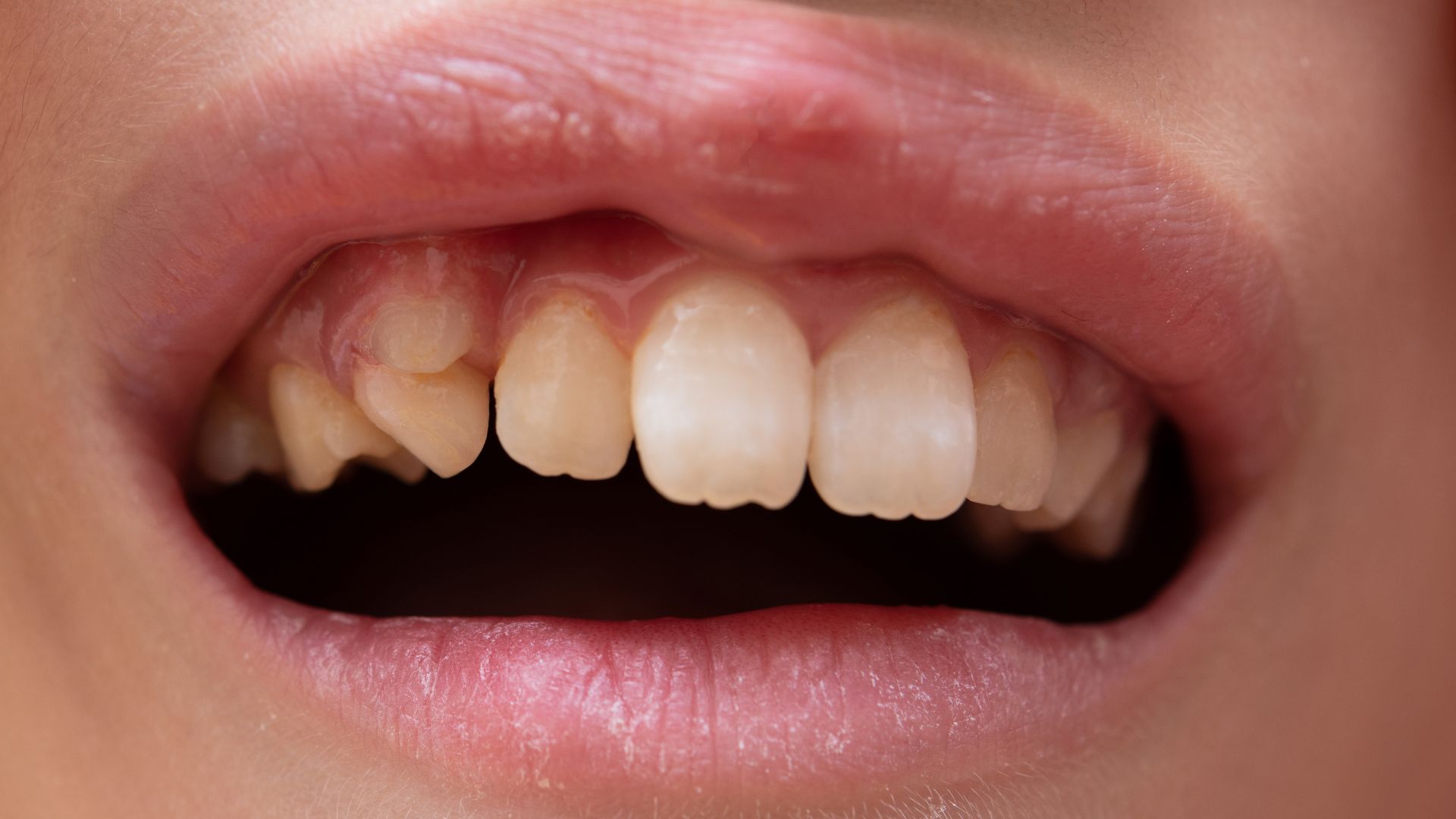 Răng sữa chưa rụng đã mọc răng mới đa số đều không nguy hiểm