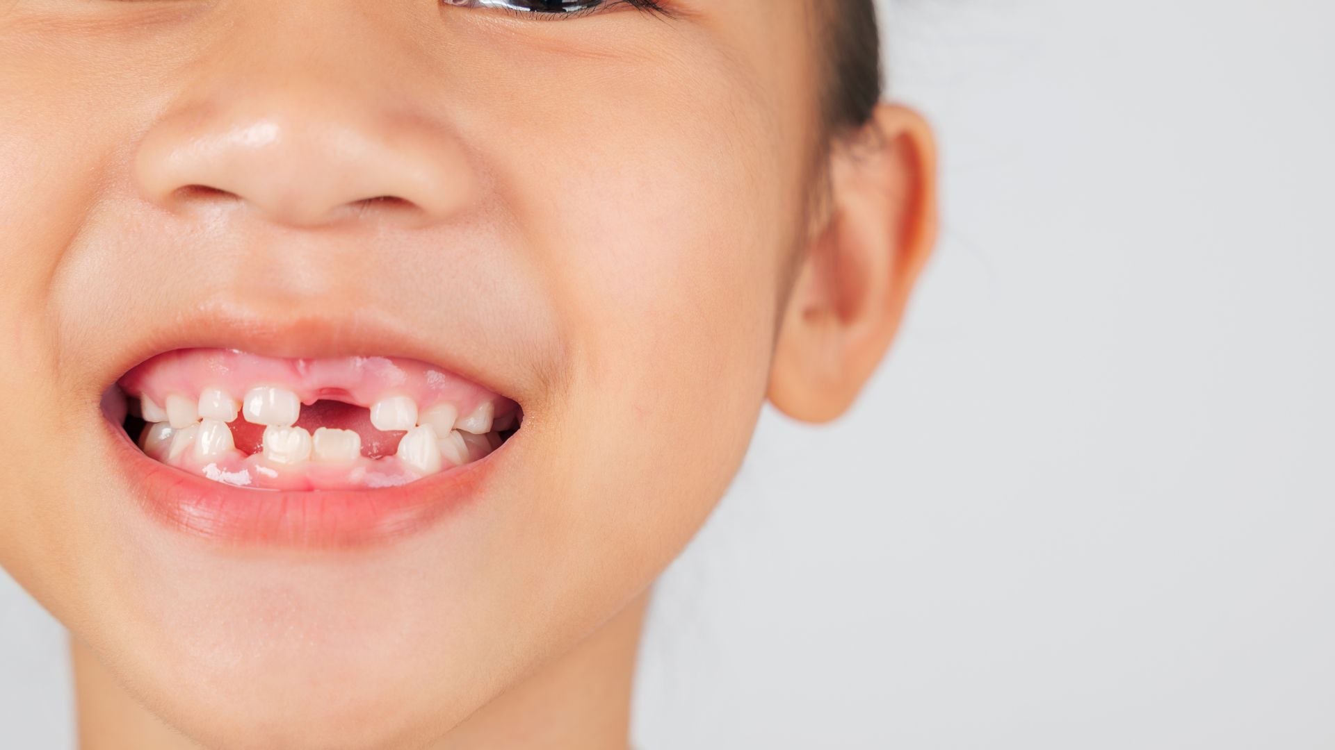 Răng vĩnh viễn mọc khi răng sữa chưa rụng là do chân răng sữa tiêu chậm