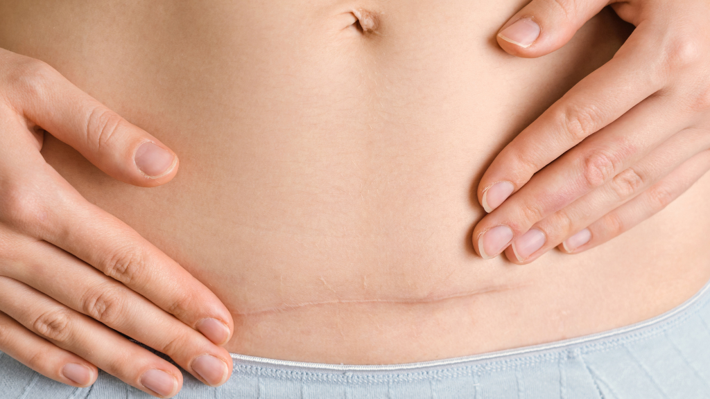 Nguy cơ mắc rau bám chặt vào tử cung có xu hướng tăng dần theo số lần mổ lấy thai trước đó