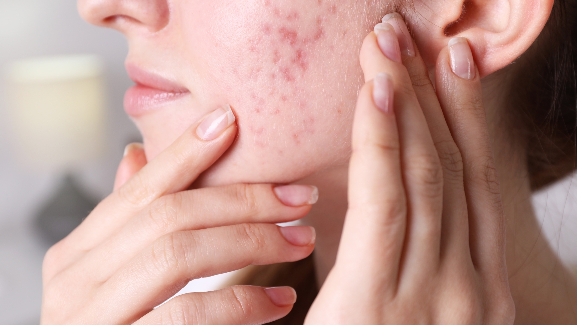 Tinh chất từ rau diếp cá được xem là “người bạn” của làn da mụn