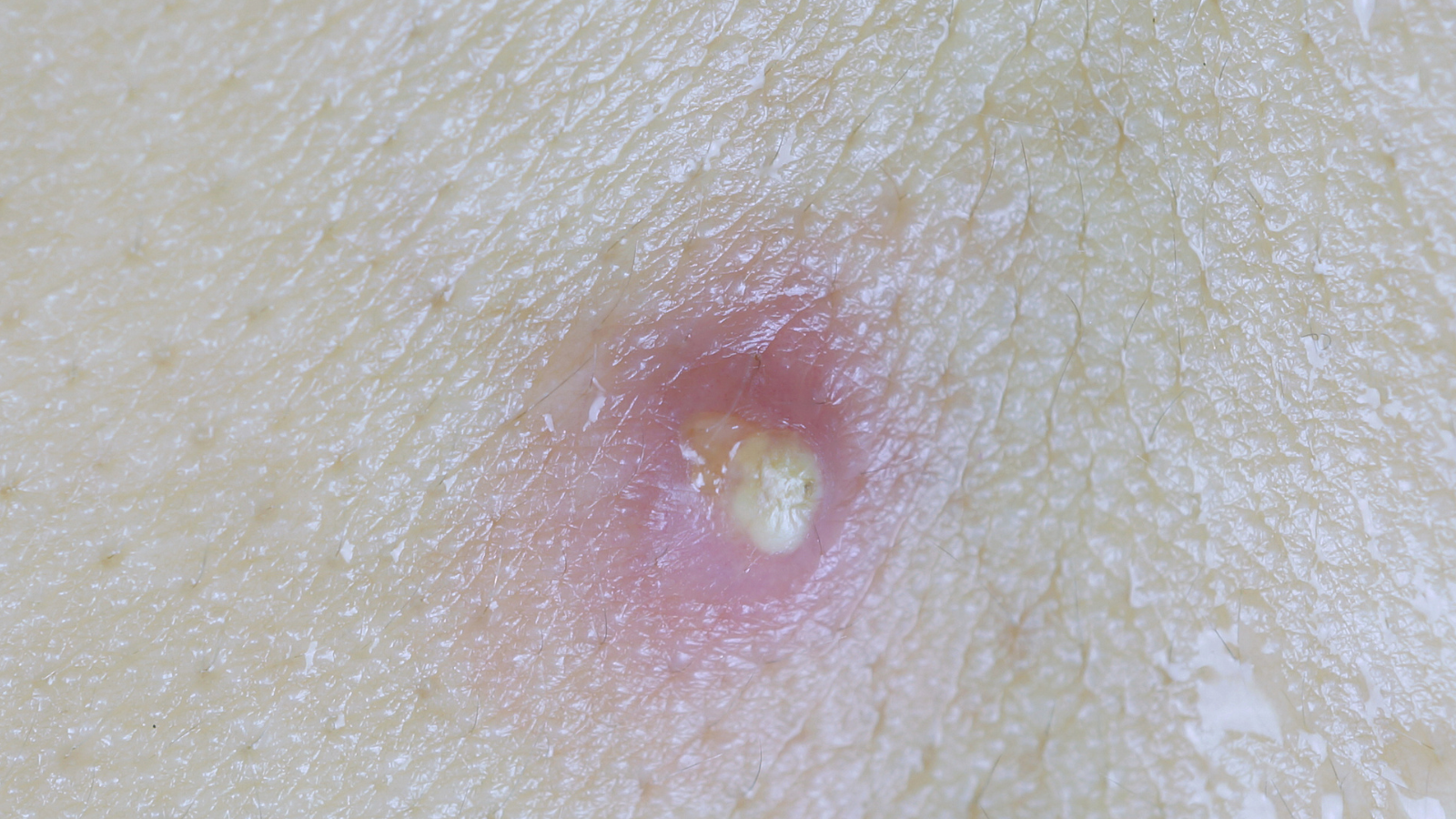 Viêm tuyến quanh hậu môn là nguyên nhân phổ biến hình thành đường rò hậu môn