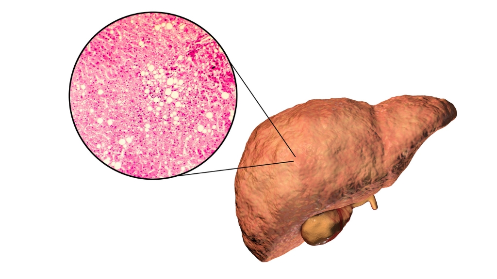 Rối loạn lipid máu có thể gây nhiều biến chứng nghiêm trọng như bệnh mạch vành, gan nhiễm mỡ