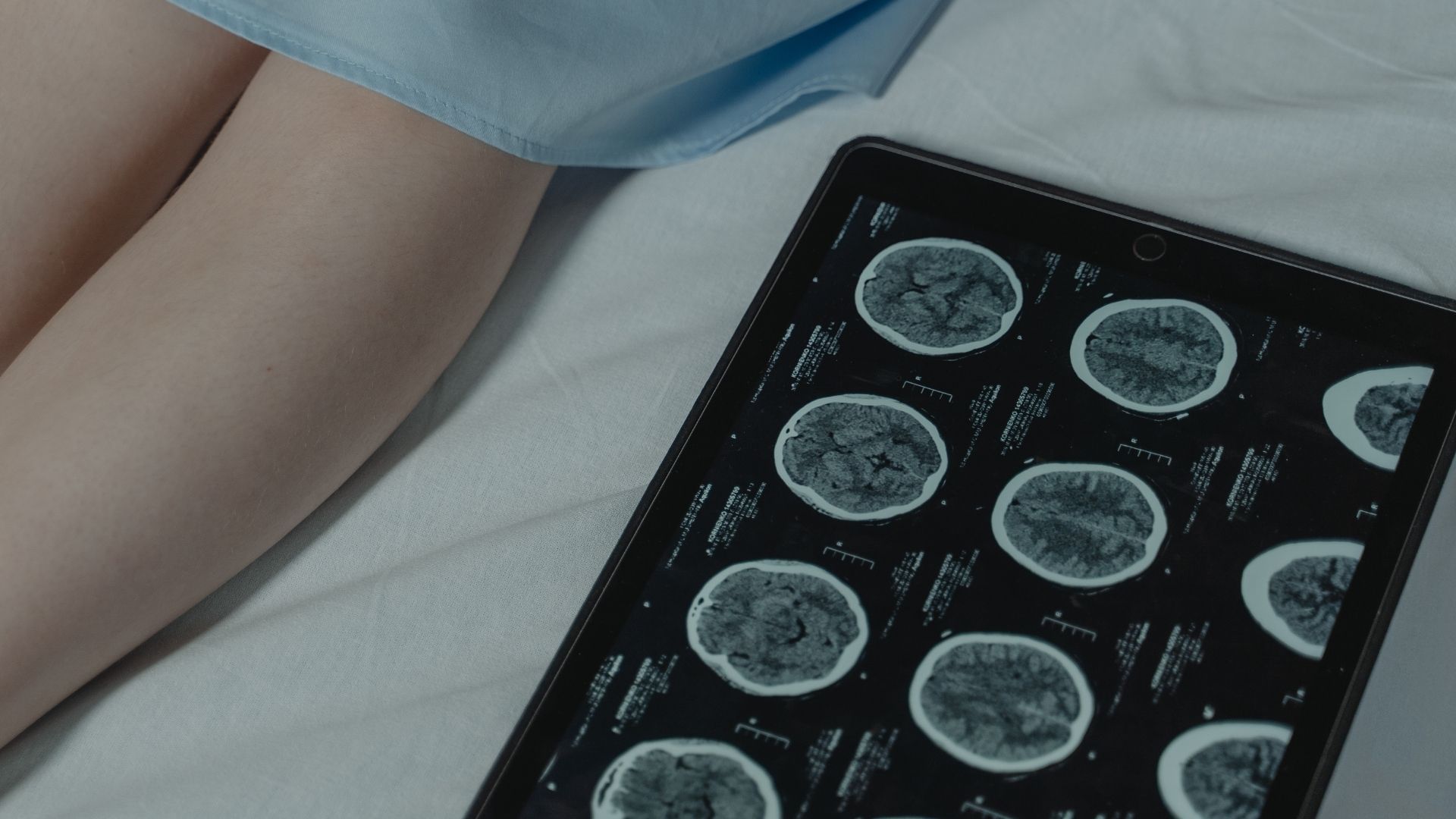 Tổn thương hệ thần kinh có thể gây rối loạn ngôn ngữ