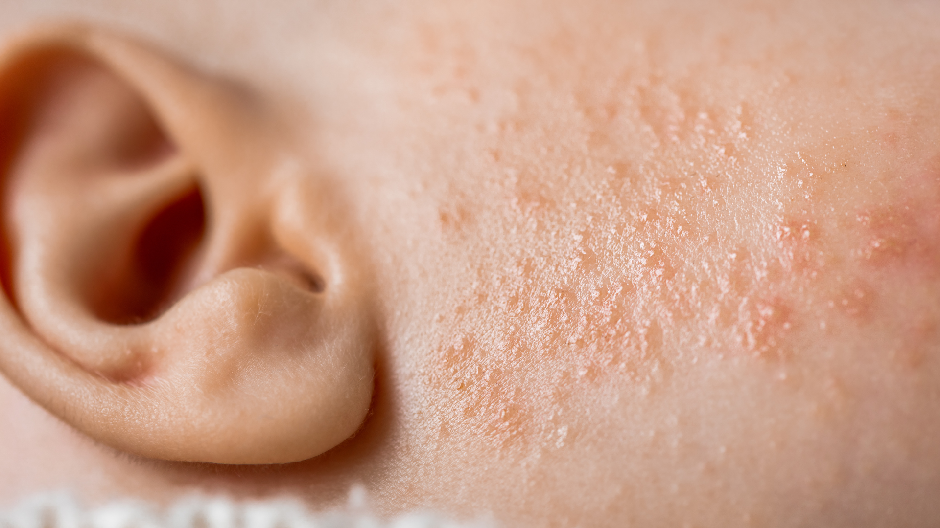 Rôm sảy kết tinh là tình trạng tắc nghẽn ống dẫn mồ hôi ở lớp trên cùng của thượng bì