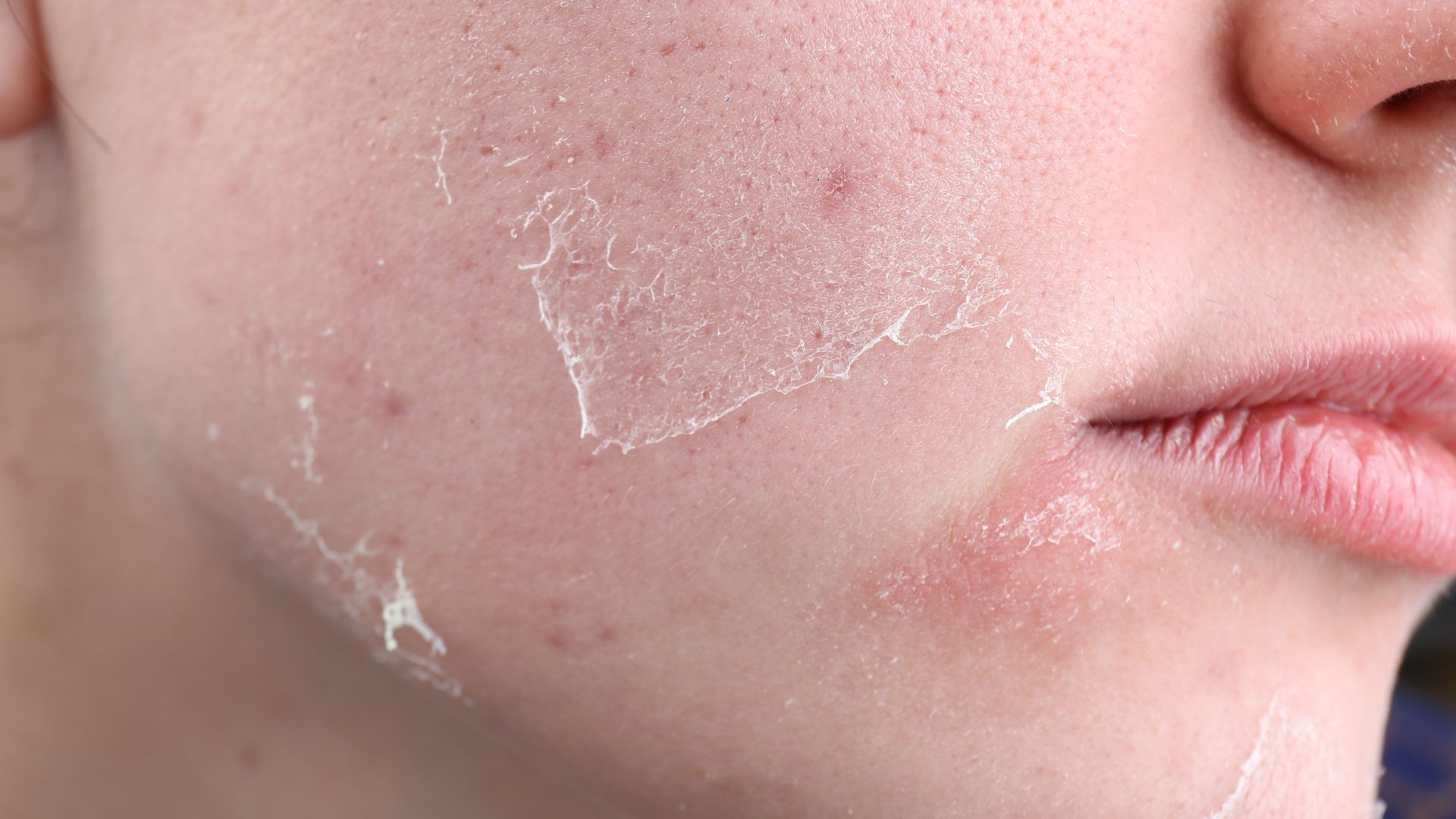 Lạm dụng nước muối sinh lý để rửa mặt có thể gây khô da