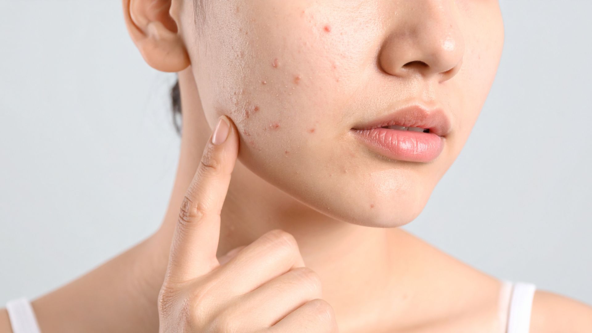 Da bị mụn viêm nhẹ có thể sử dụng nước muối sinh lý để rửa mặt