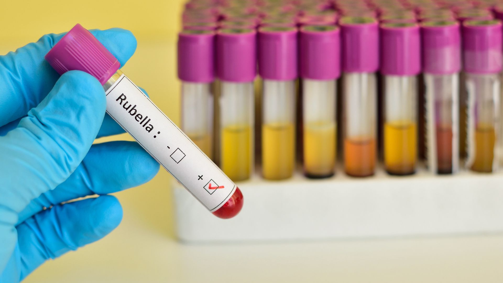 rubella-trieu-chung-nguyen-nhan-chan-doan-dieu-tri-va-phong-ngua 3.jpg