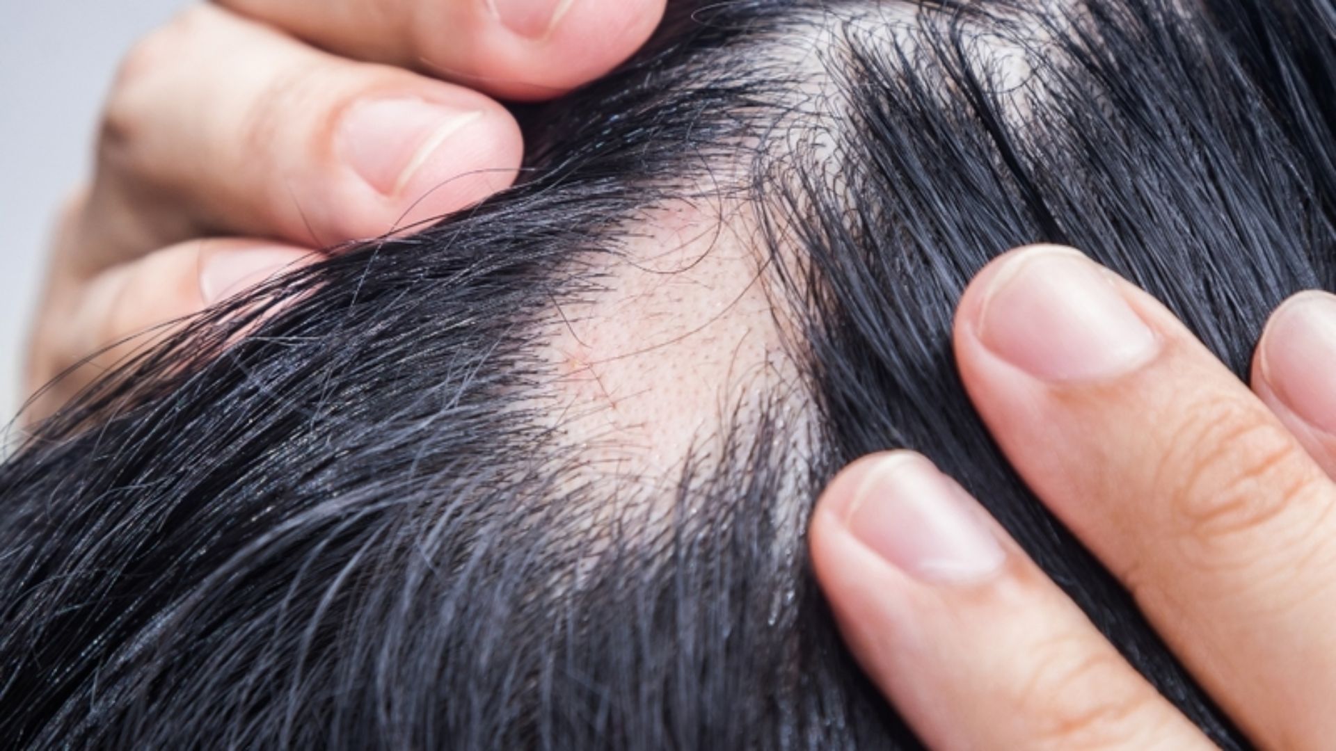 Rụng tóc từng mảng là tình trạng mà không ít độc giả đang phải đối mặt