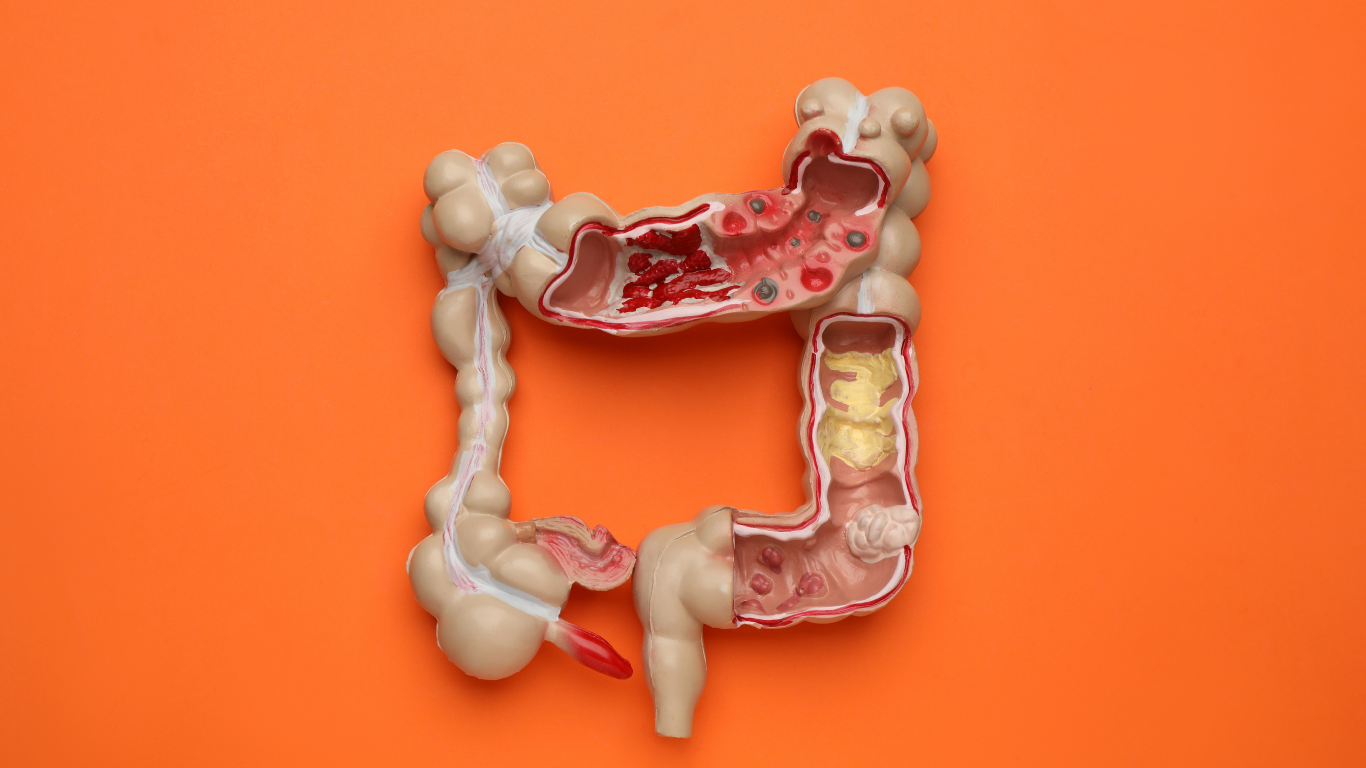 Ruột già là cơ quan dễ bị ảnh hưởng bởi chế độ ăn uống, lối sống và nhiều yếu tố khác