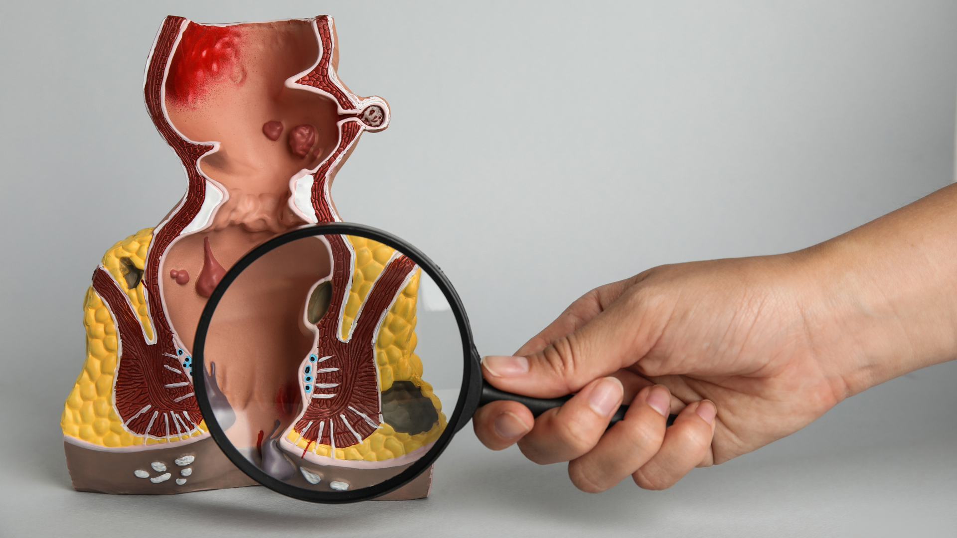 Khả năng búi trĩ tự co lại phụ thuộc trực tiếp vào mức độ tiến triển của bệnh