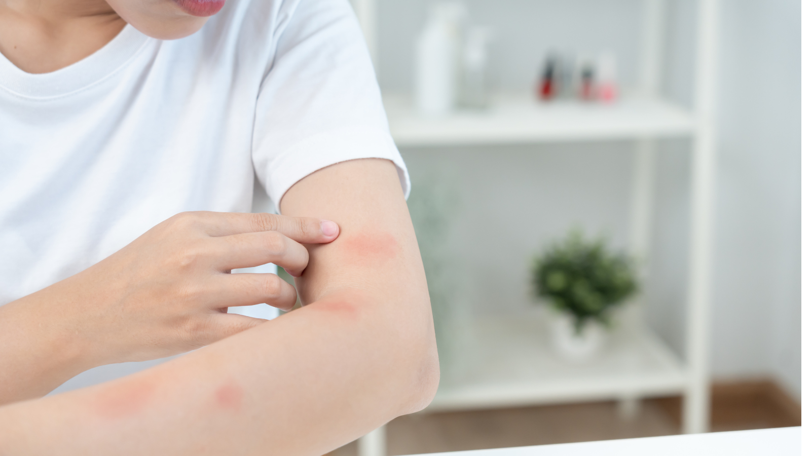 Sạm da sau chàm tổ đỉa, thường kéo dài nhiều tháng