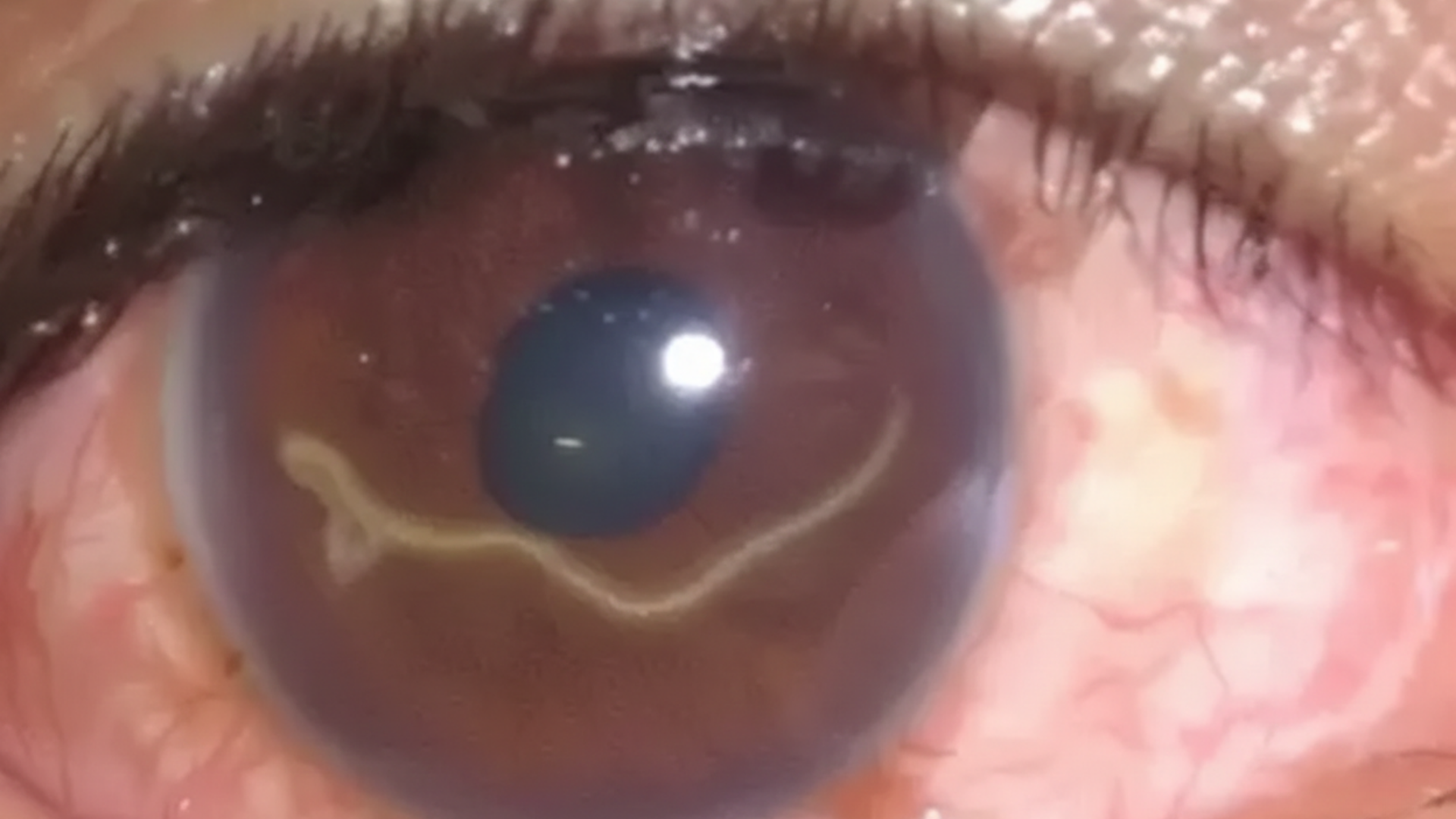 Hiểu đúng khái niệm sán chó ở mắt