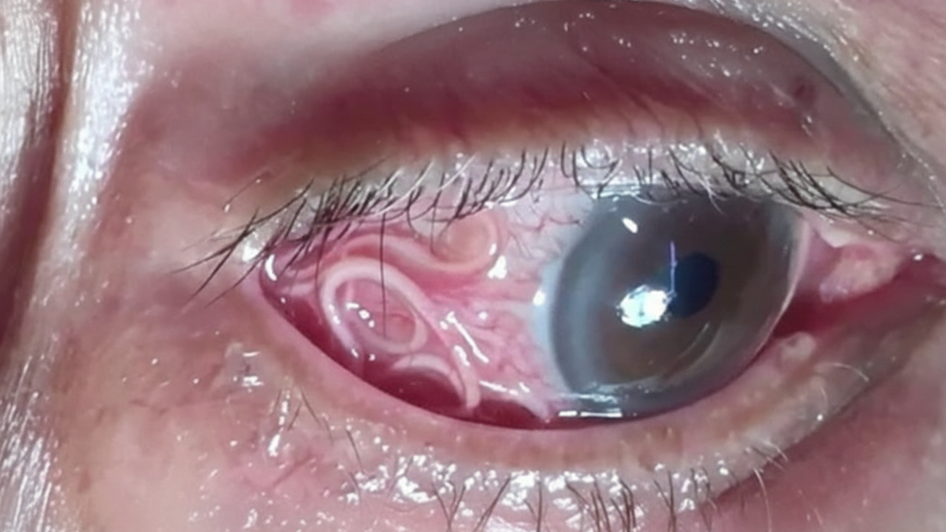 Dấu hiệu sán chó ở mắt thường gặp