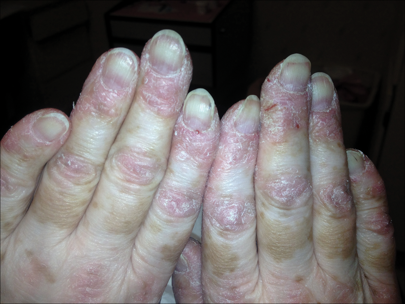 Sẩn gottron thường đối xứng hai bên, xuất hiện ở khớp bàn tay, khớp ngón