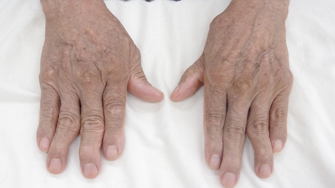 Người mắc viêm khớp dạng thấp có nguy cơ bị sẩn gottron cao hơn