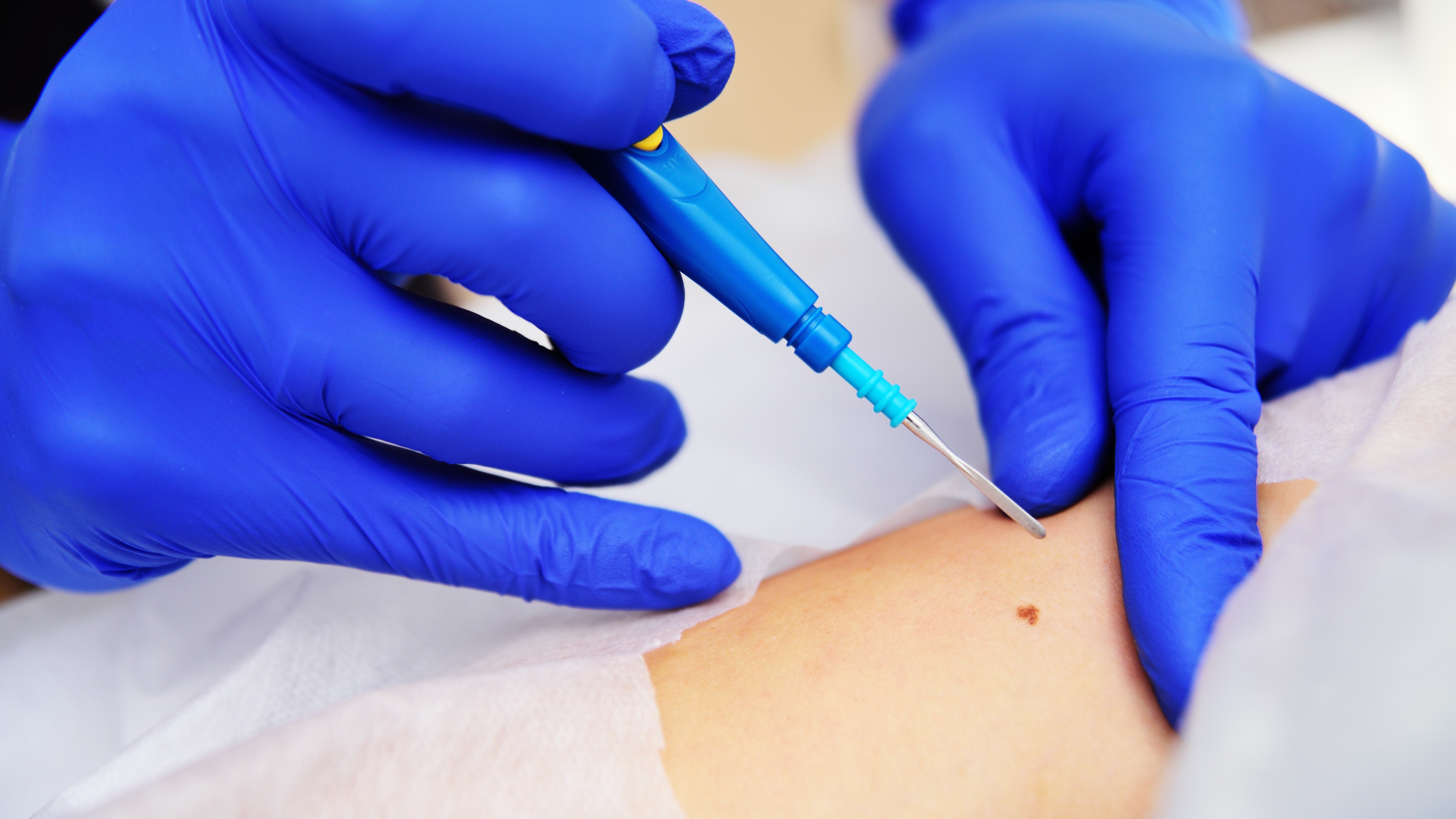 Sinh thiết da là phương pháp giúp phát hiện tình trạng viêm và hoại tử