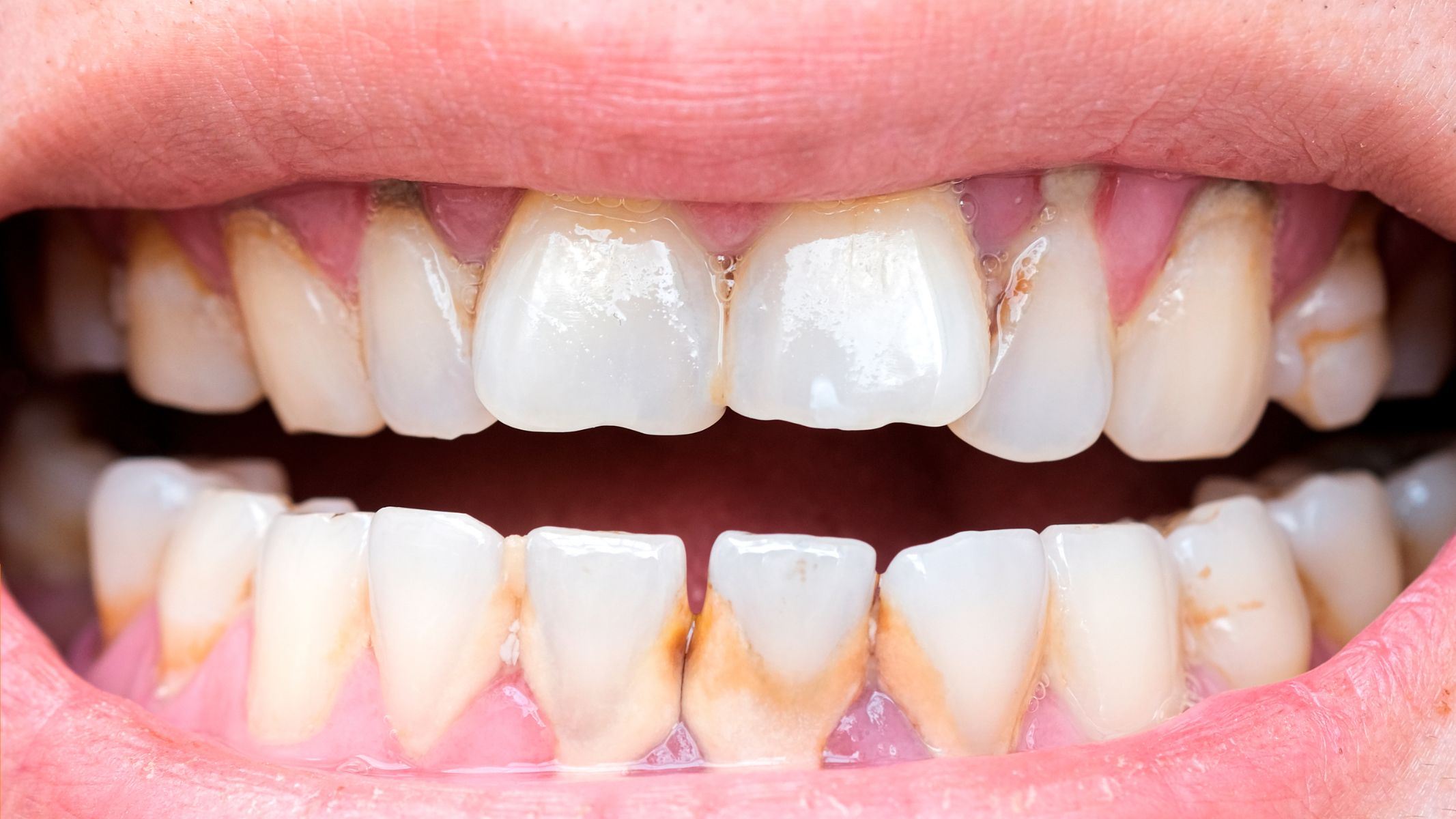 Khi bị sâu, chân răng có thể chuyển sang vàng sẫm, nâu hoặc đen