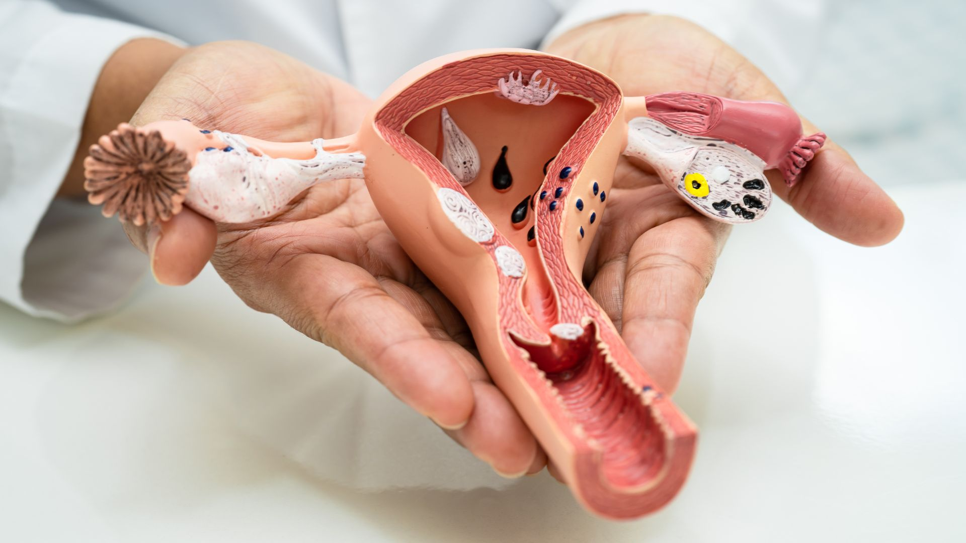 Dịch máu nâu sau chuyển phôi có thể do cổ tử cung yếu hoặc viêm nhẹ, cần theo dõi dấu hiệu bất thường