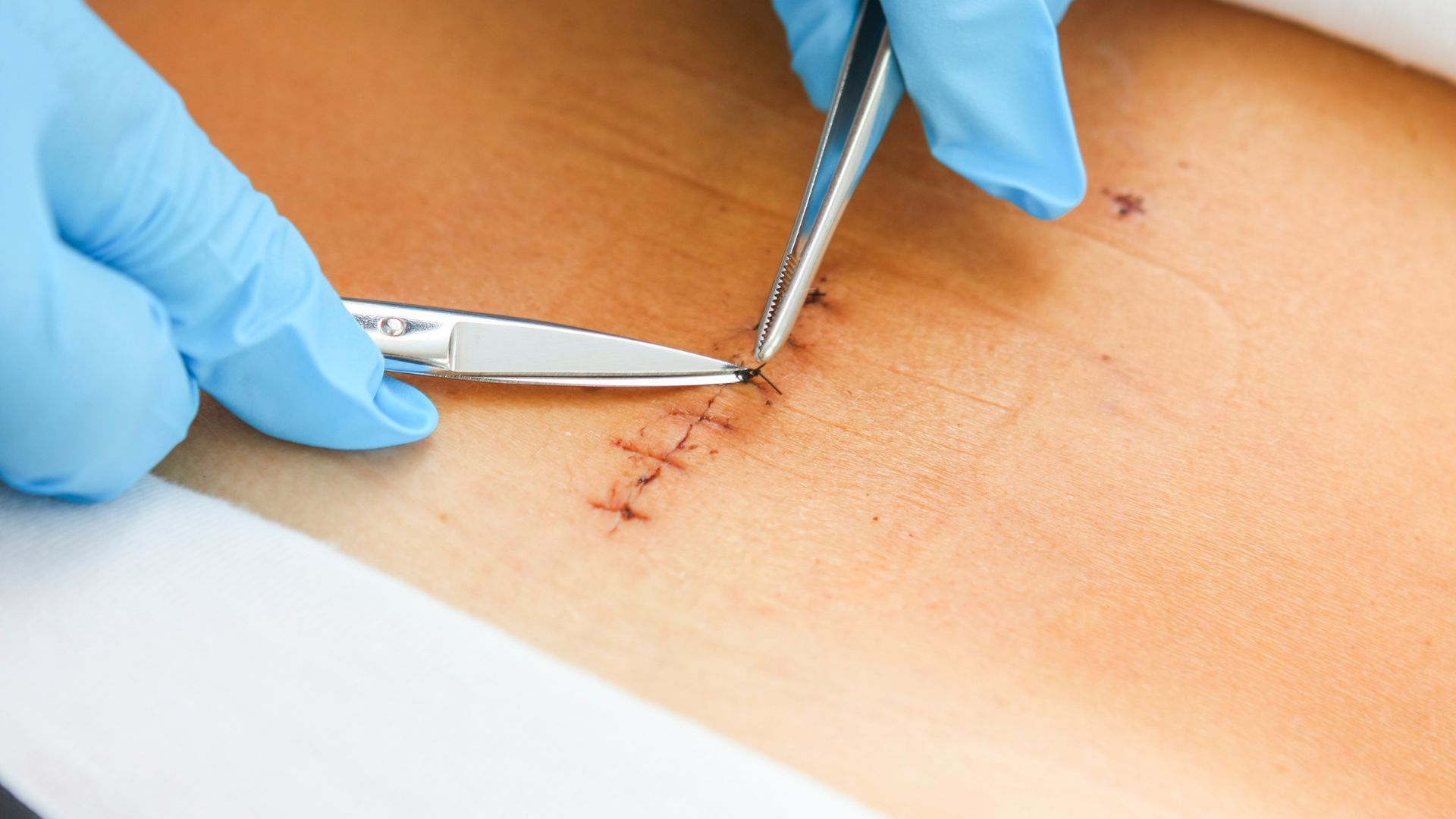 Sau khi cắt chỉ vết thương cần làm gì là thắc mắc của nhiều người bệnh