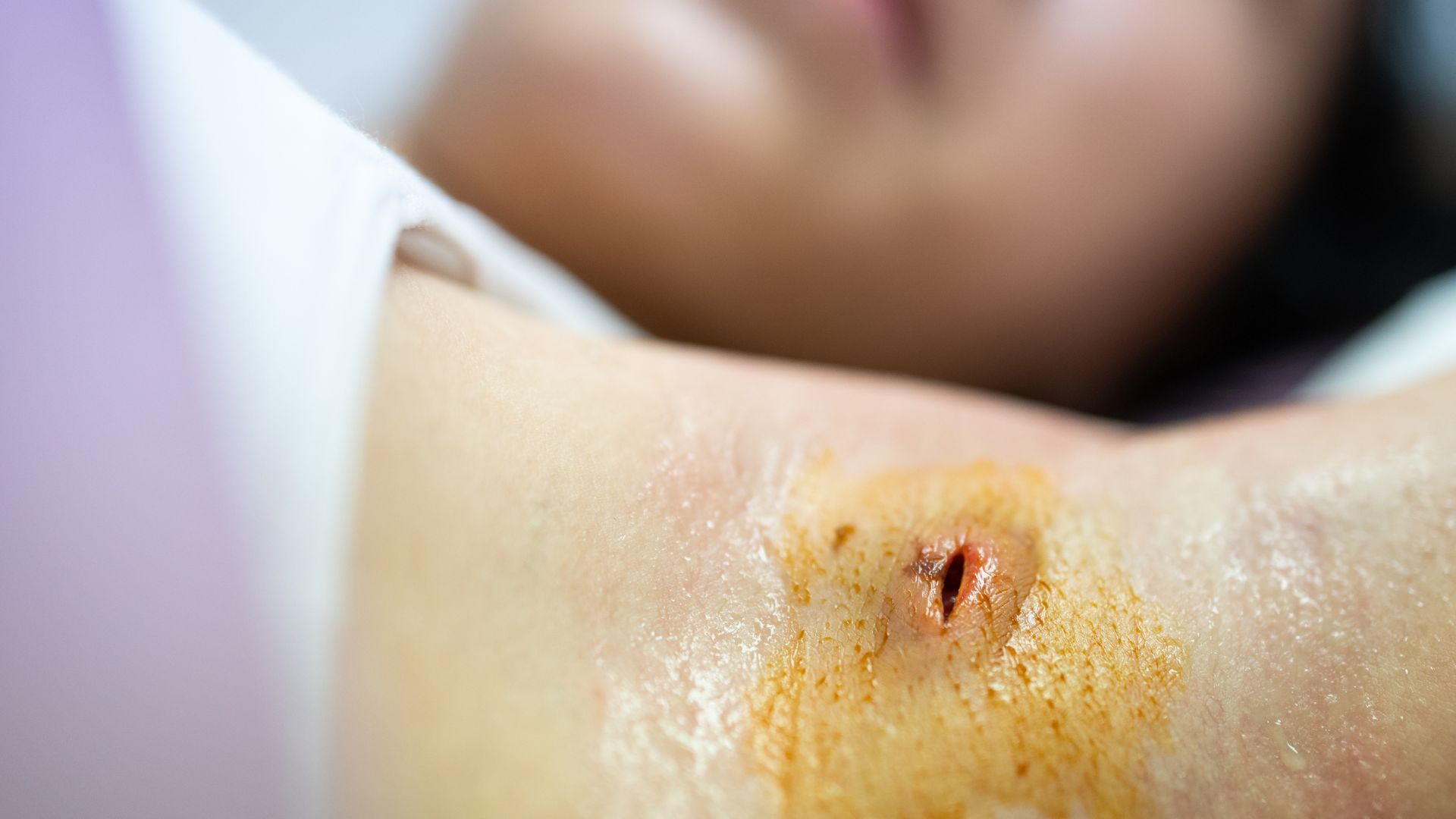 Người bệnh nên sử dụng dung dịch sát khuẩn để vệ sinh vết thương đúng cách