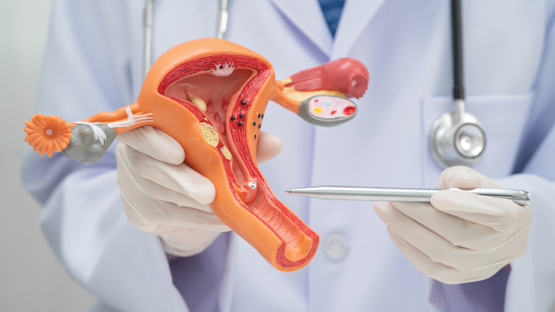 Tình trạng nội mạc tử cung là một yếu tố cốt lõi để quyết định thời điểm chuyển phôi sau khi chọc hút trứng