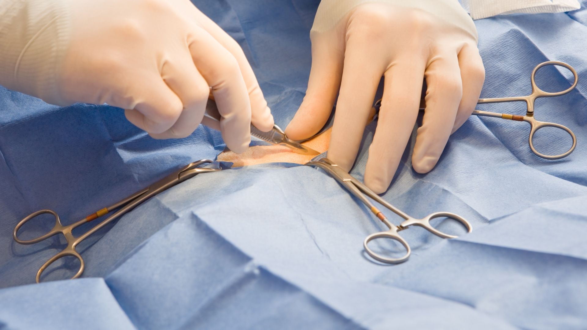 Vị trí vết mổ là một yếu tố quyết định thời gian quan hệ lại ở người bệnh sau mổ